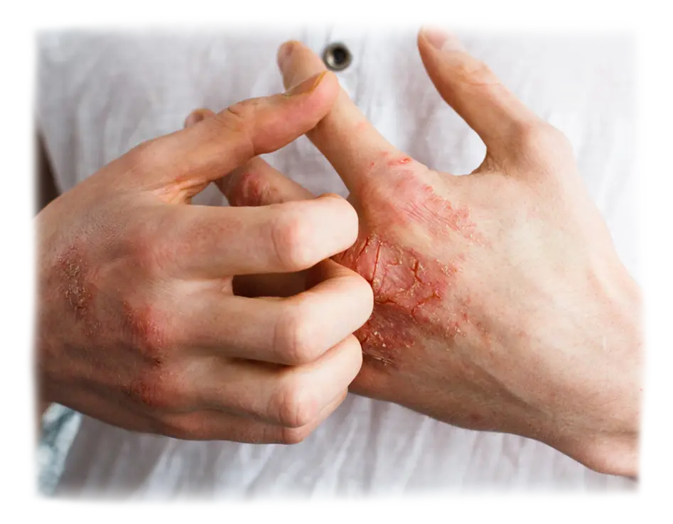 Eczema (Vicharchika)