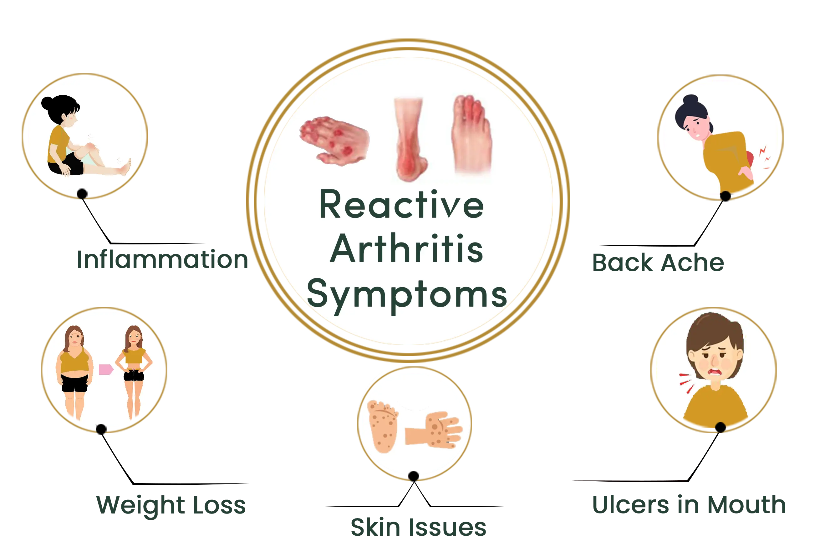Reactive Arthritis Symptoms