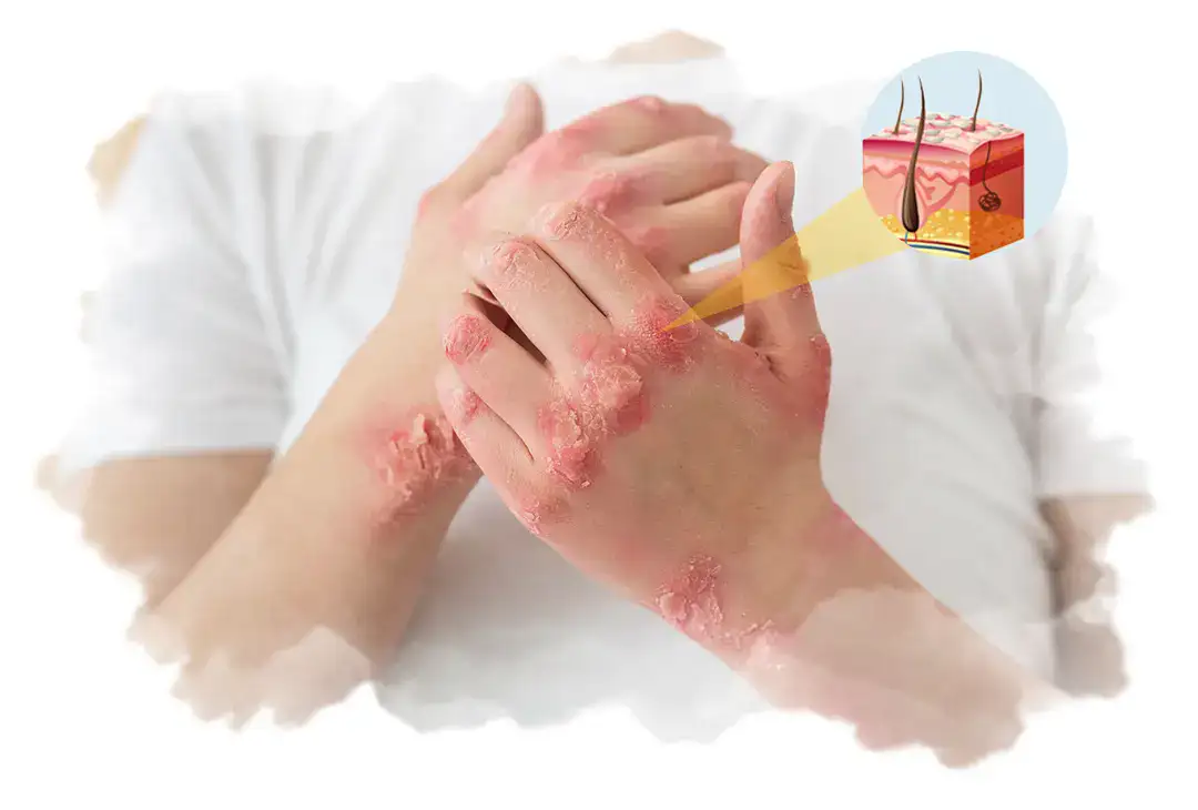 vector diagram showing internal skin of psoriasis condition on hand