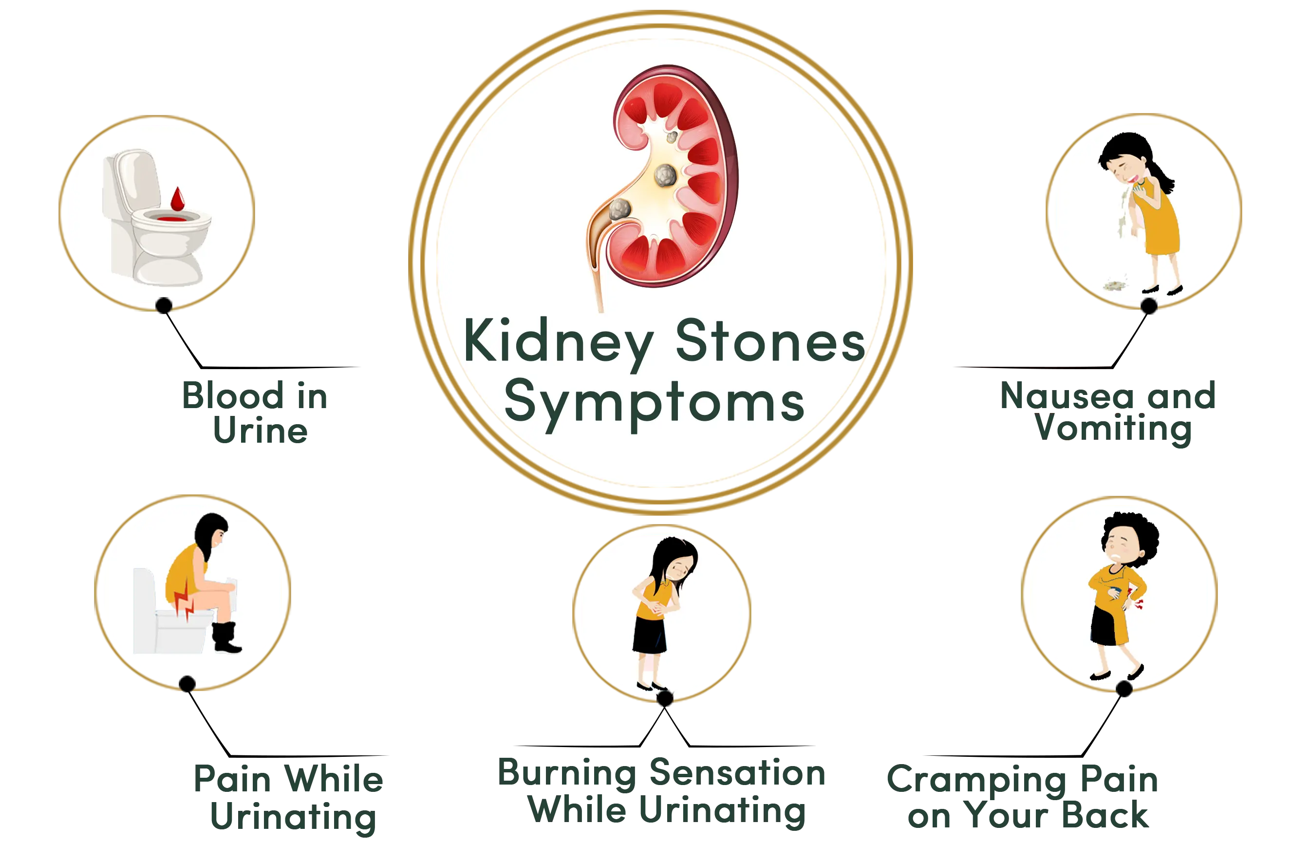 Kidney Stones symptoms