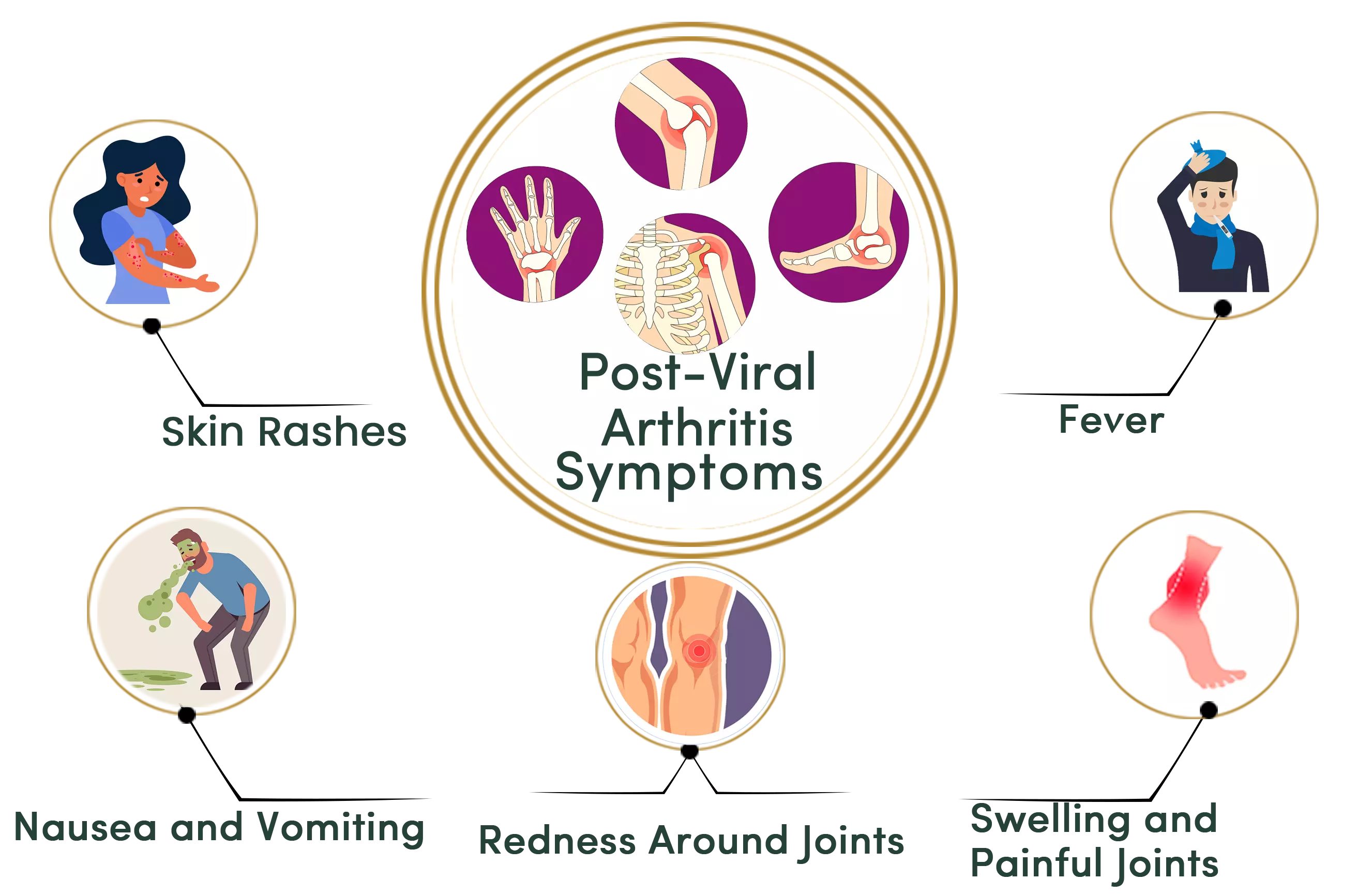 Post-Viral Arthritis symptoms