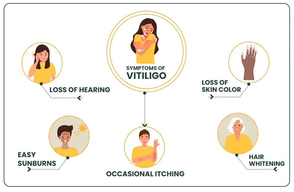 symptoms of vitiligo