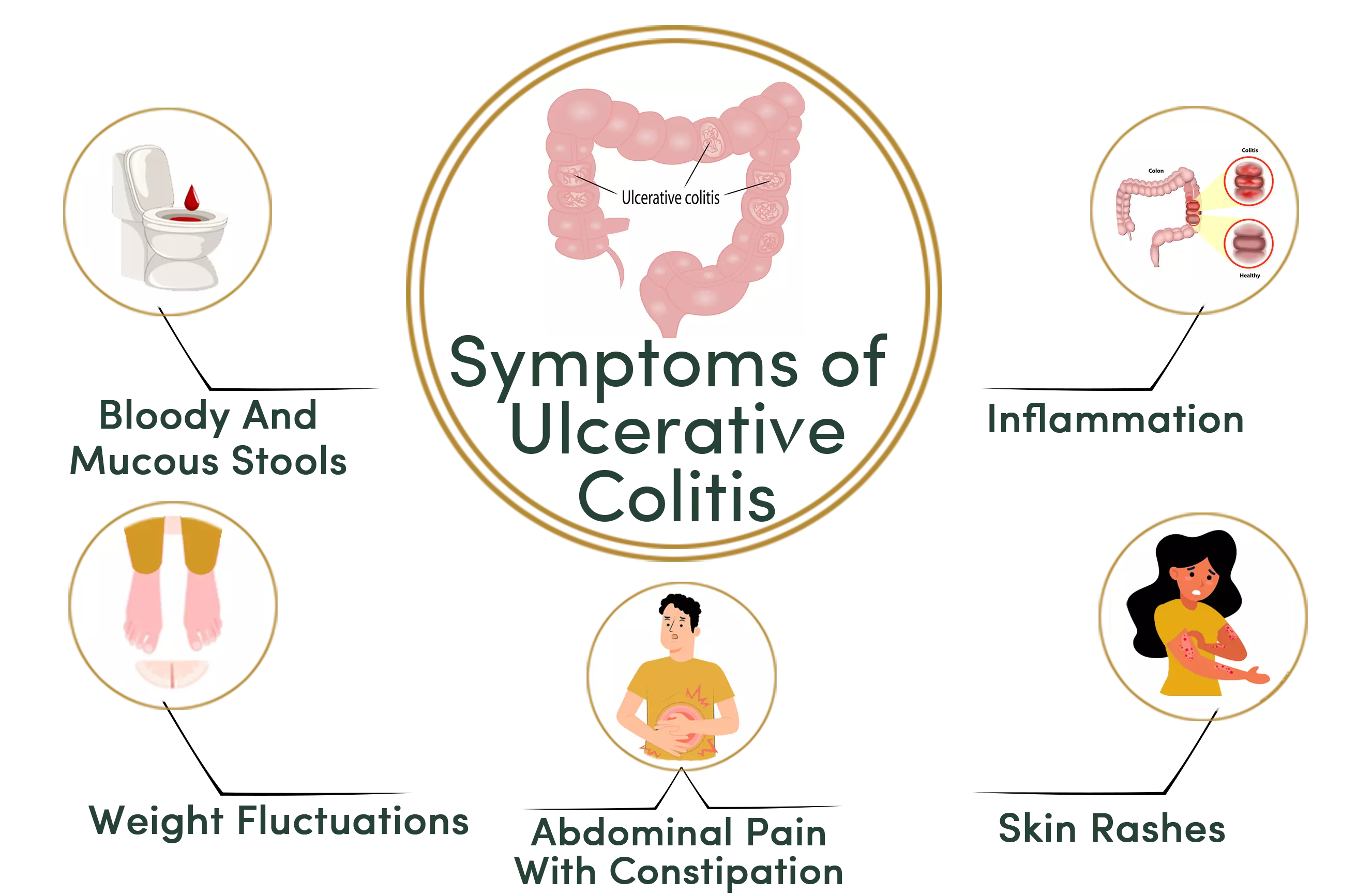 Ulcerative Colitis symptoms