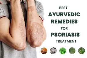 Best Ayurvedic Remedies for Psoriasis Treatment