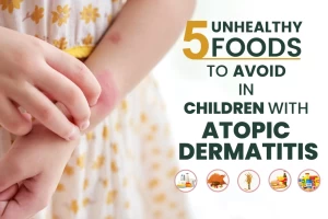 5 Unhealthy Foods To Avoid In Children With Atopic Dermatitis