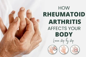 Learn about 4 Stages of Rheumatoid Arthritis and How it affects your Body