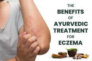 The Benefits of Ayurvedic Treatment for Eczema: A Comprehensive Guide