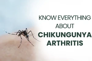 Know everything about Chikungunya arthritis treatment with Ayurveda