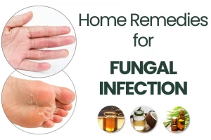 Top 10 Effective Home Remedies for Recovering From Fungal Infection According To Ayurveda