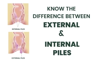 Know the Difference between External and Internal Piles