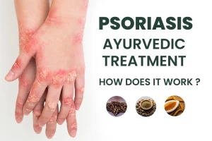 Psoriasis Ayurvedic Treatment & How Does It Work?