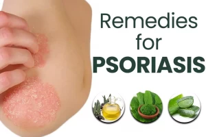 Best Ayurvedic Remedies To Cure Psoriasis Recommended By Experts