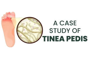 A case study on successful Ayurvedic treatment of Tinea Pedis